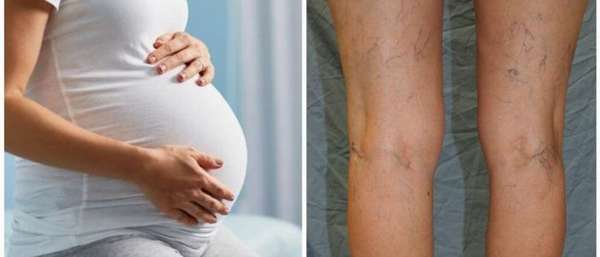 беременность и варикозные проявления